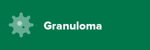 Granuloma